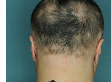 Columbia University Medical Trials Find Potential Cure for Alopecia ruxolitinib Belgravia Centre