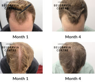 male pattern hair loss the belgravia centre 372096