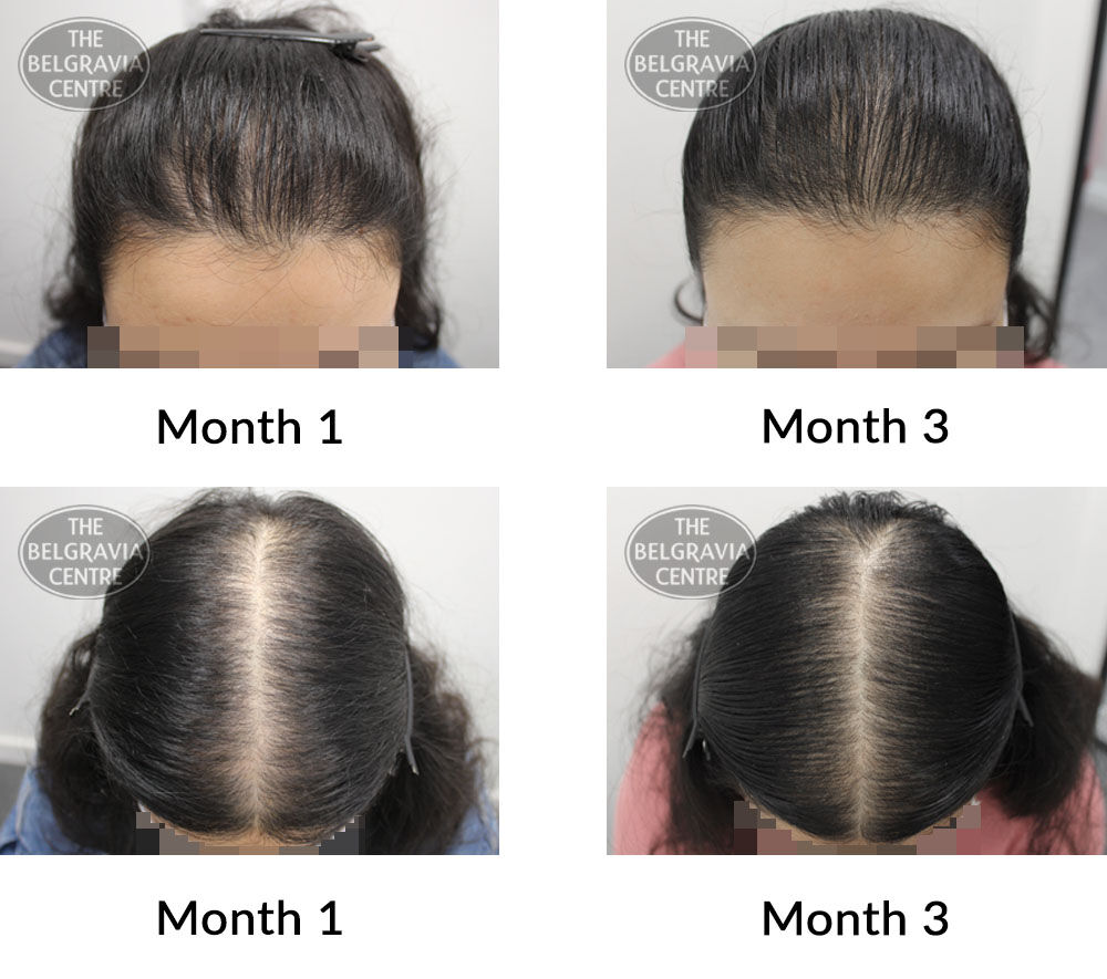 female pattern hair loss the belgravia centre 393036 16 09 2021
