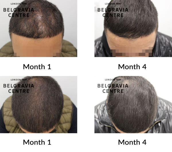 male pattern hair loss the belgravia centre 425919
