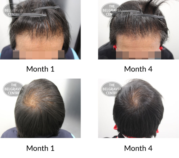 male pattern hair loss the belgravia centre 398161 15 11 2021