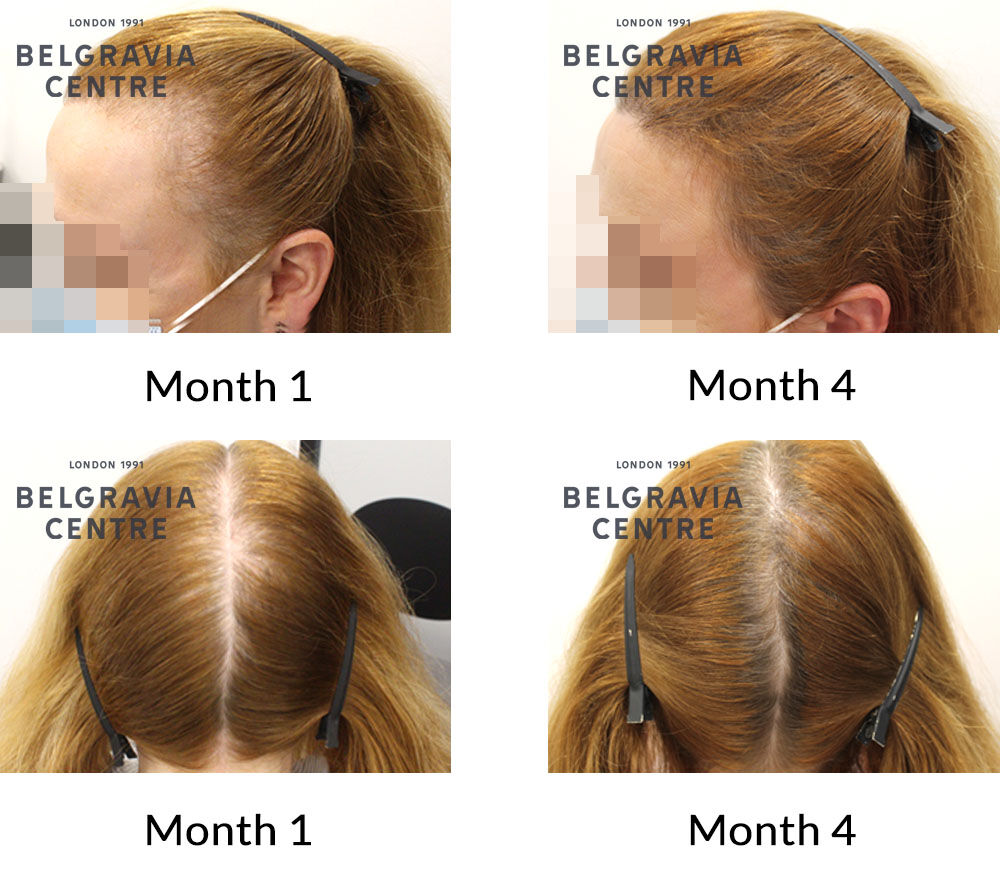 female pattern hair loss and post partum alopecia the belgravia centre 431774