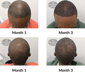 alert male pattern hair loss the belgravia centre 421522 20 08 2021