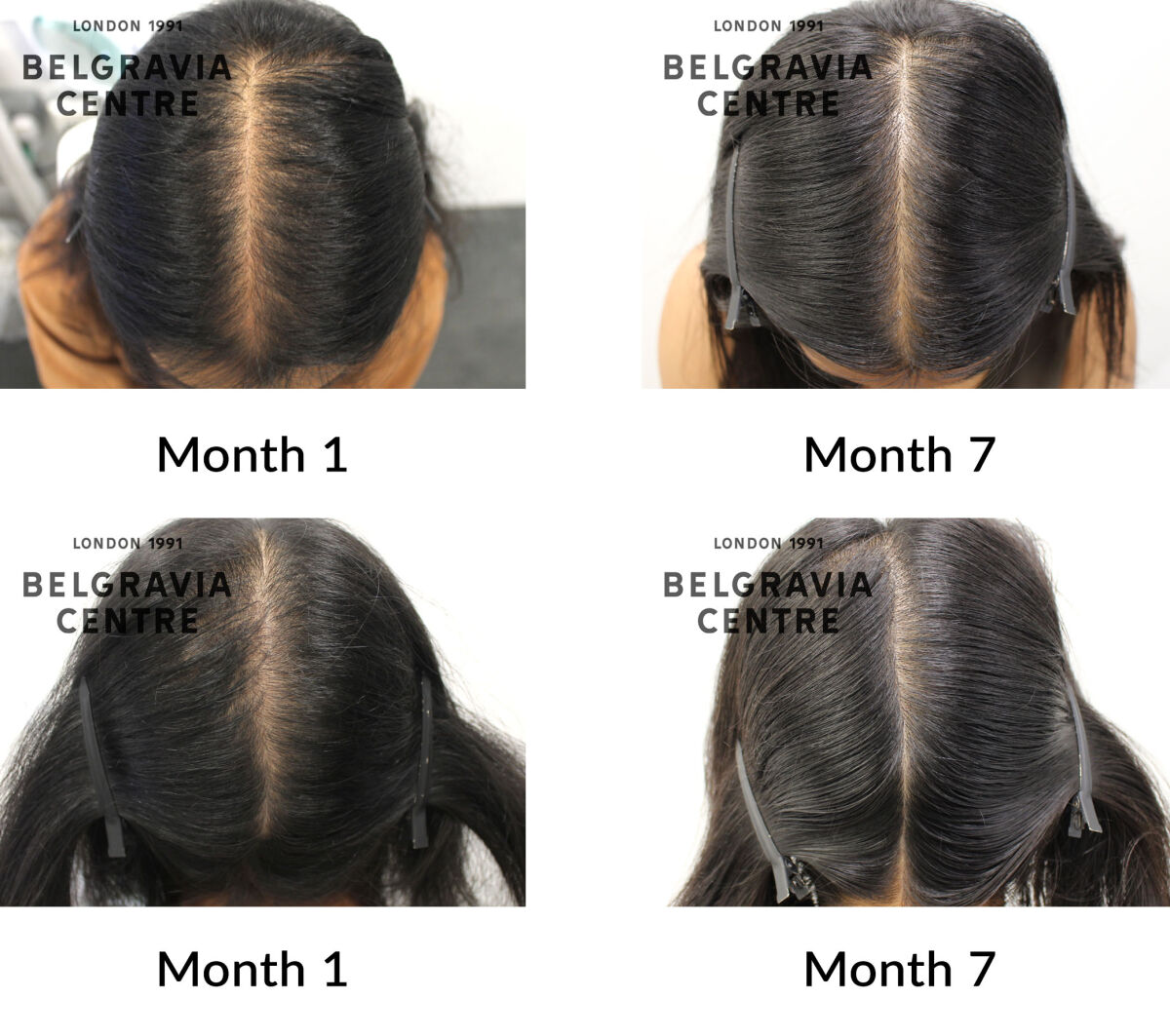 female pattern hair loss the belgravia centre 430915