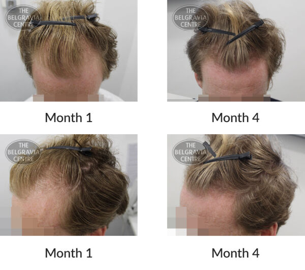 male pattern hair loss the belgravia centre 393497 20 11 2020