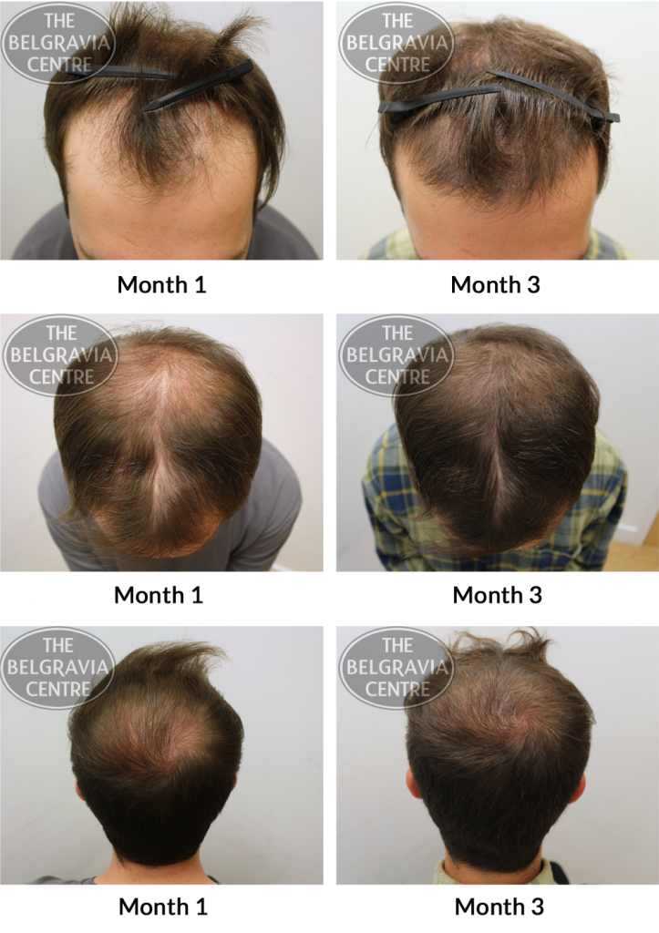 Male Pattern Hair Loss The Belgravia Centre JM 10 04 723x1024