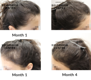 female pattern hair loss the belgravia centre 458028