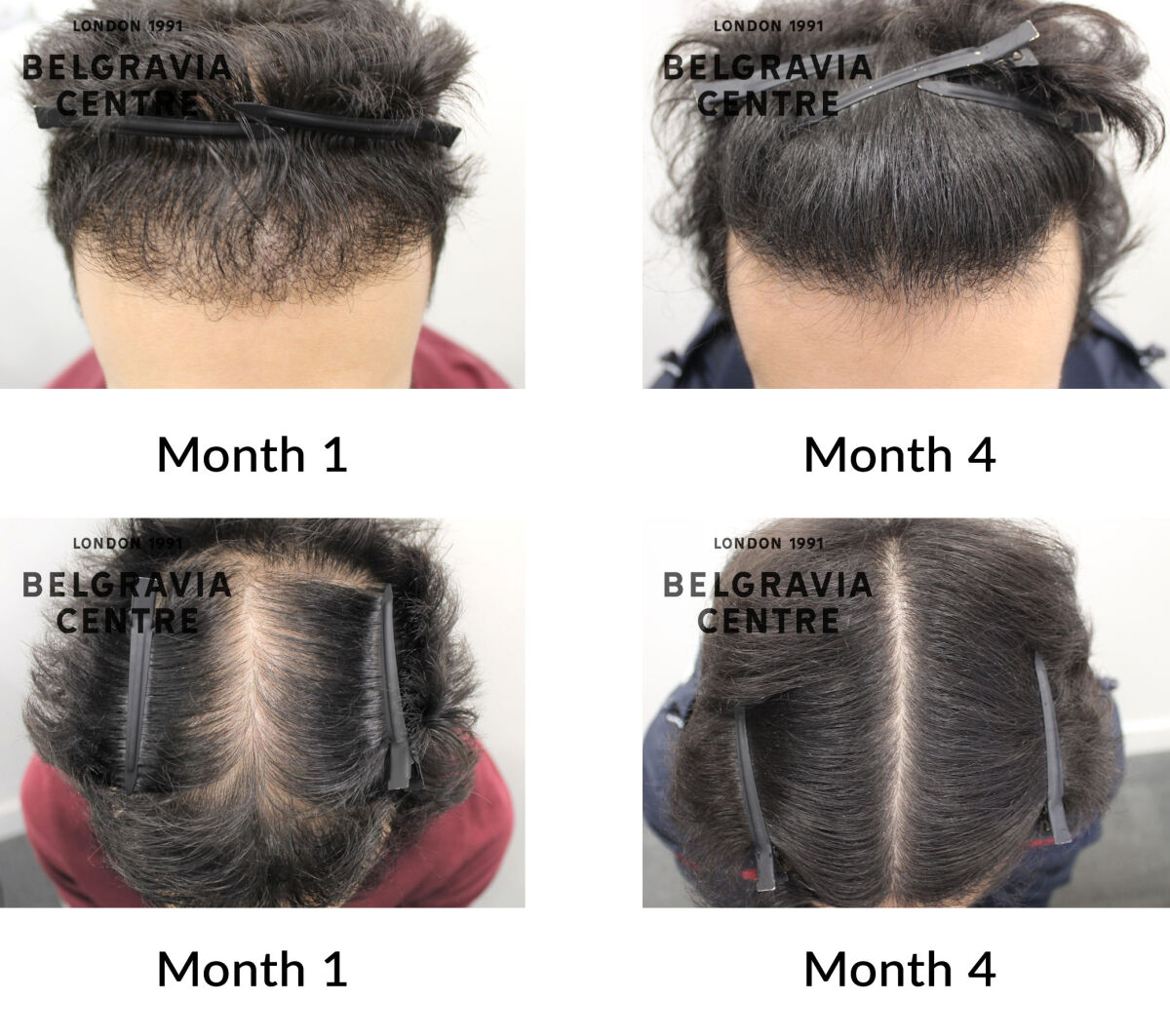 male pattern hair loss the belgravia centre 444105