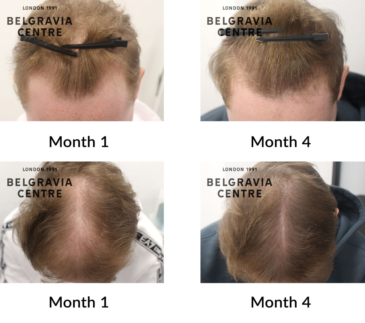 male pattern hair loss the belgravia centre 442244