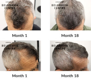 male pattern hair loss the belgravia centre 297214