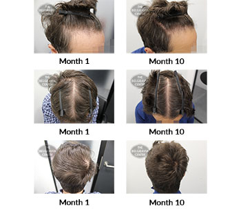 alert male pattern hair loss the belgravia centre 407424 19 07 2021