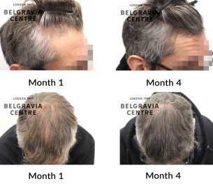 male pattern hair loss the belgravia centre 465369