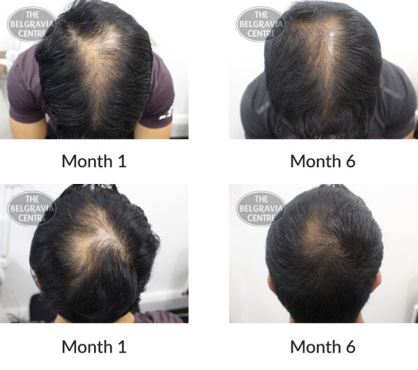 male pattern hair loss the belgravia centre 395719 18 11 2020