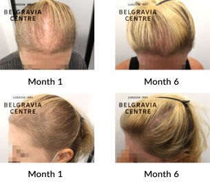 female pattern hair loss and telogen effluvium the belgravia centre 433341