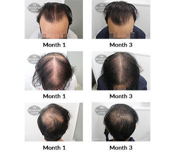 alert male pattern hair loss the belgravia centre 425627 19 11 2021