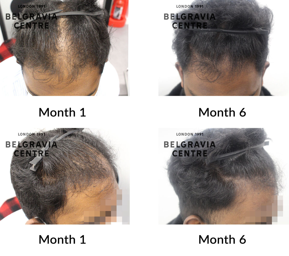 male pattern hair loss the belgravia centre 430256
