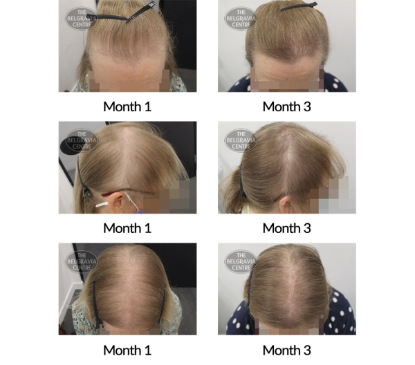 female pattern hair loss and diffuse thinning the belgravia centre 407978 16 12 2020