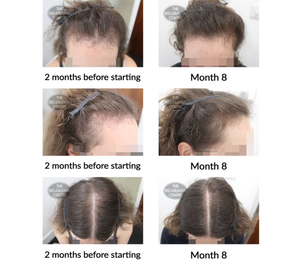 female pattern hair loss and diffuse thinning the belgravia centre 404979 23 04 2021