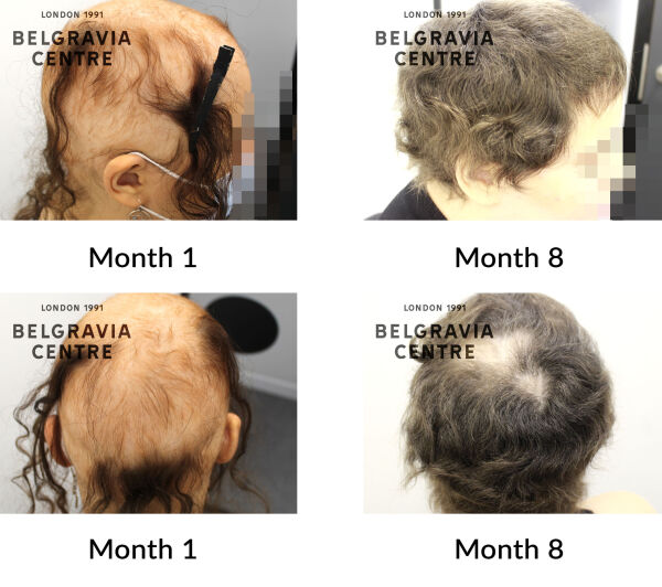 alopecia areata and alopecia areata diffuse the belgravia centre 427995