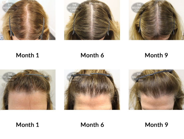 female pattern hair loss the belgravia centre 364870 18 06 2019