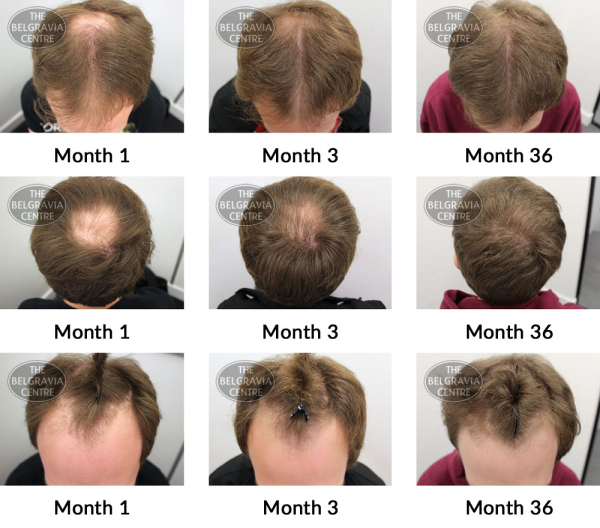 male pattern hair loss the belgravia centre 305964 16 05 2019