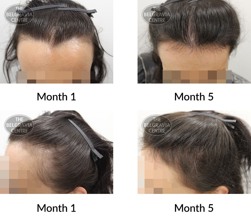 female pattern hair loss the belgravia centre 389438 23 07 2020 1