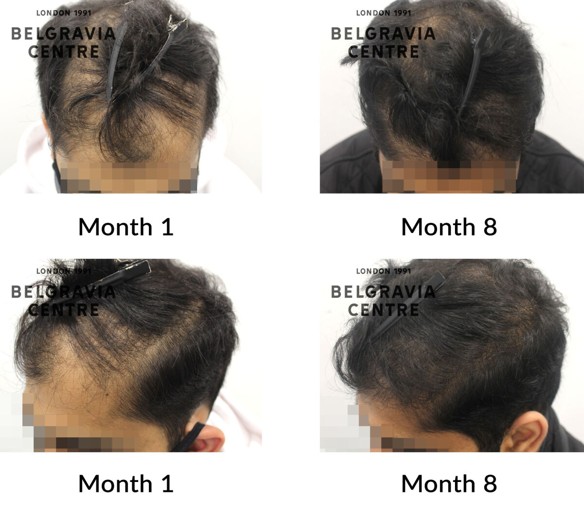 male pattern hair loss the belgravia centre 409942