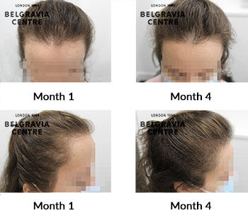 alert female pattern hair loss and Telogen Effluvium chronic the belgravia centre 432144 3