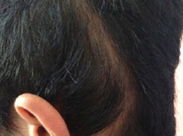 Linear Alopecia Lupus