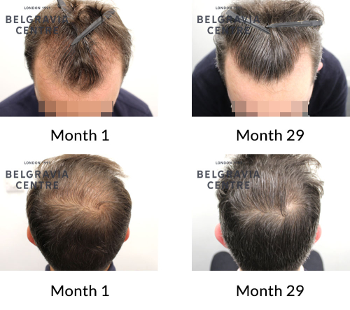 male pattern hair loss the belgravia centre 387756