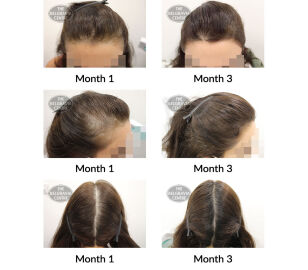 female pattern hair loss and diffuse hair loss the belgravia centre 424287 25 08 2021