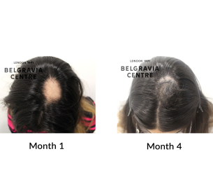 alopecia areata the belgravia centre 441836