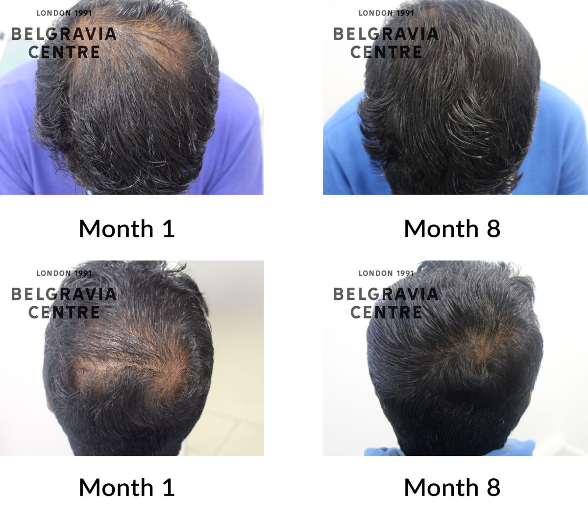 male pattern hair loss the belgravia centre 425691