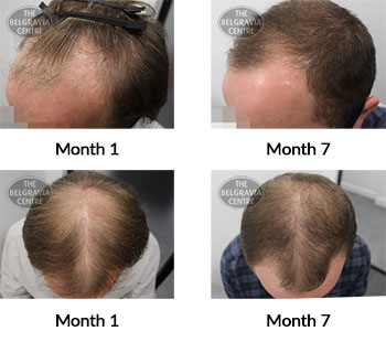 alert male pattern hair loss the belgravia centre 408486 10 05 2021
