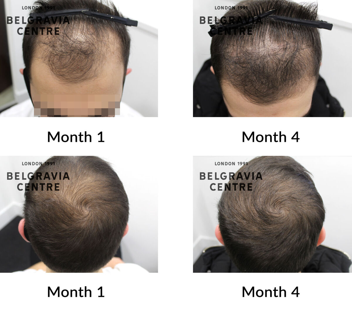male pattern hair loss the belgravia centre 433423