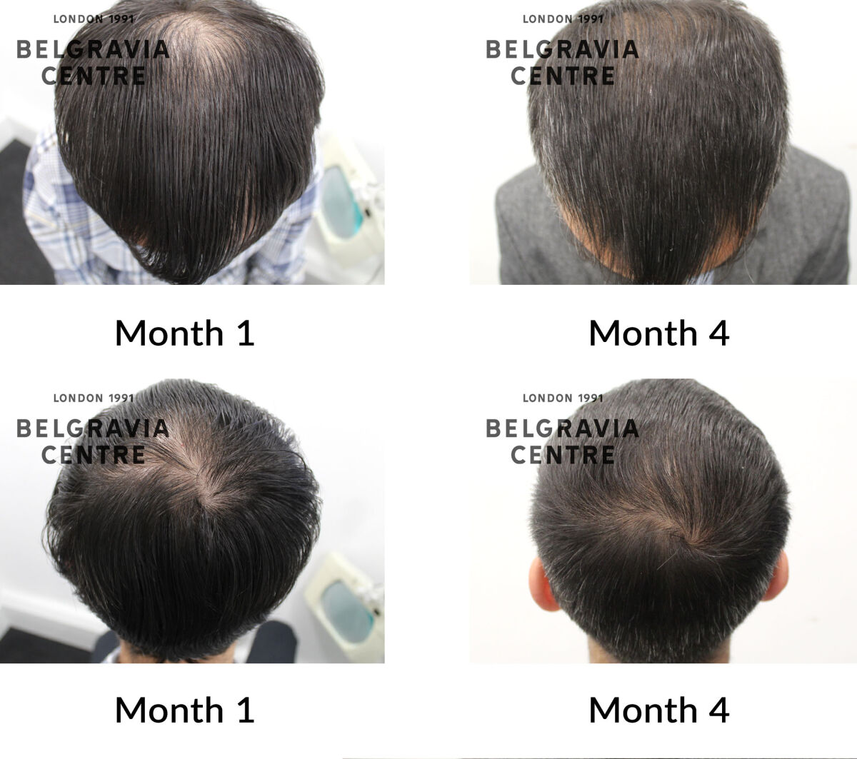 male pattern hair loss the belgravia centre 437054