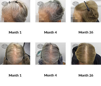 alert female pattern hair loss the belgravia centre 381878 22 06 2021