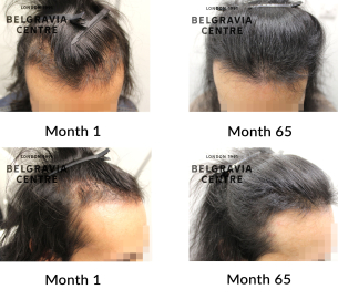 male pattern hair loss the belgravia centre 363090
