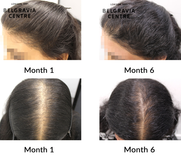 female pattern hair loss the belgravia centre 449397