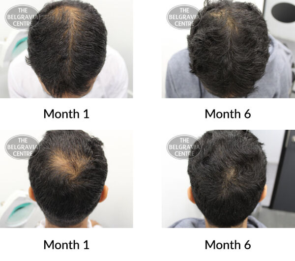 male pattern hair loss the belgravia centre 389317 27 08 2020