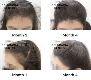 female pattern hair loss the belgravia centre 433220