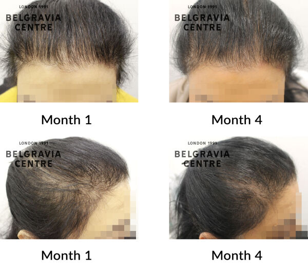 female pattern hair loss and diffuse thinning the belgravia centre 434339