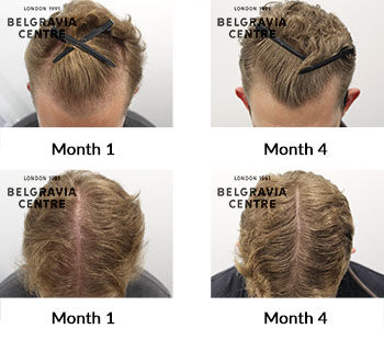 alert male pattern hair loss the belgravia centre 430978