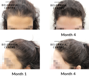 telogen effluvium and female pattern hair loss the belgravia centre 465757