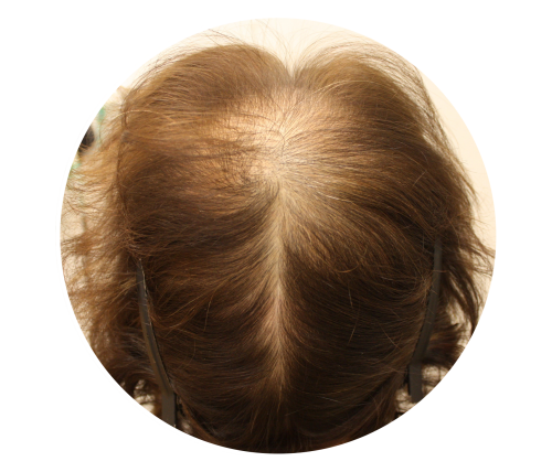 Female Pattern Hairloss