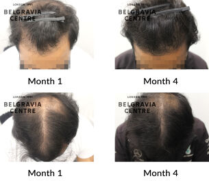 male pattern hair loss the belgravia centre 437344
