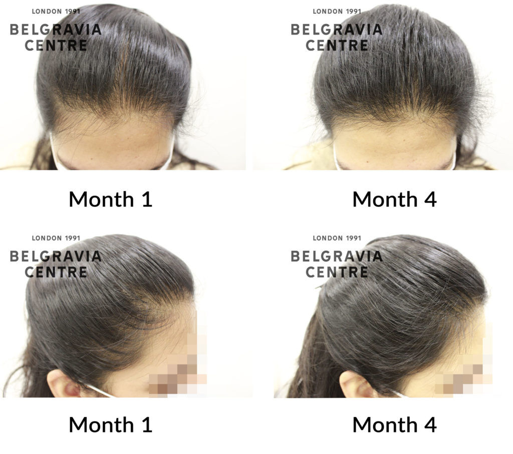 female pattern hair loss the belgravia centre 431677 1024x907