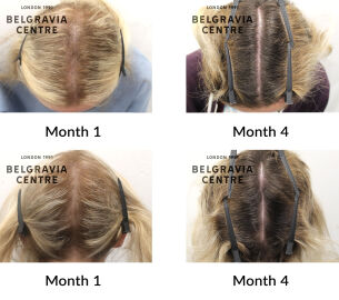 diffuse thinning and hair breakage the belgravia centre 438759