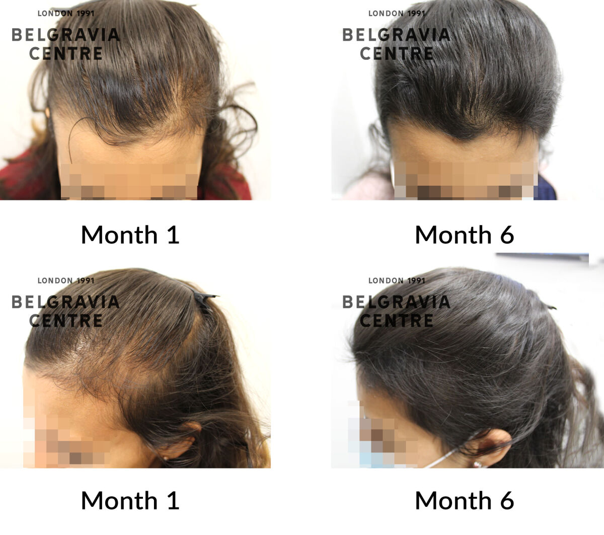 female pattern hair loss the belgravia centre 317919