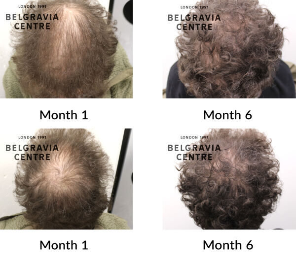 female pattern hair loss the belgravia centre 449625